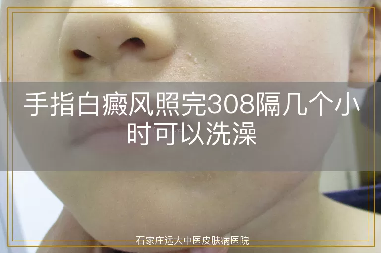手指白癜风照完308隔几个小时可以洗澡
