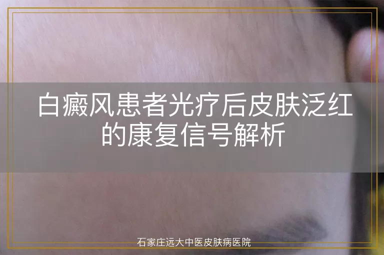 白癜风患者光疗后皮肤泛红的康复信号解析