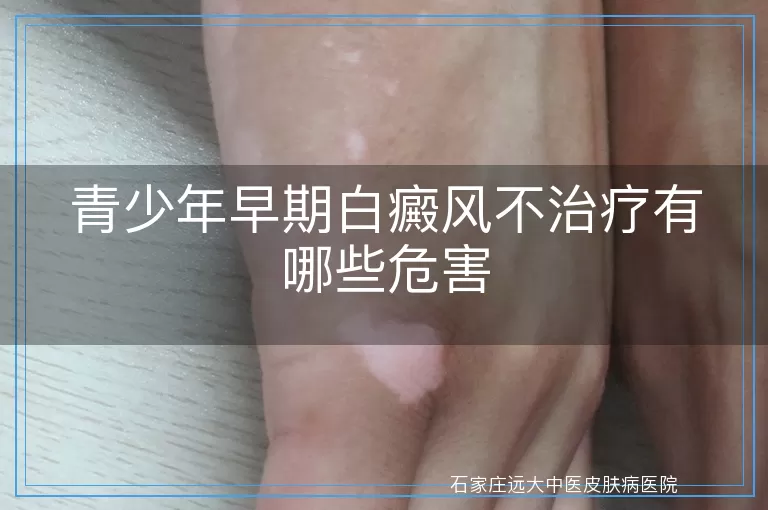 青少年早期白癜风不治疗有哪些危害