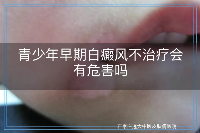 青少年早期白癜风不治疗会有危害吗