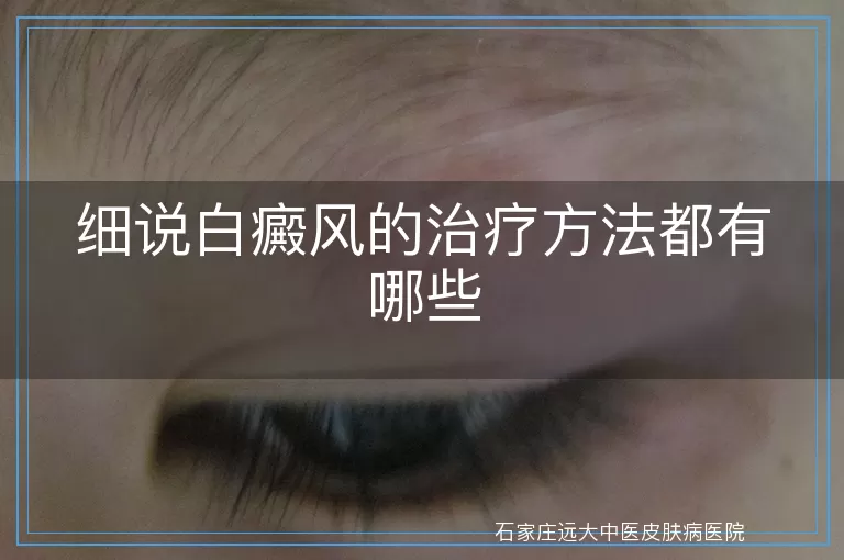 细说白癜风的治疗方法都有哪些