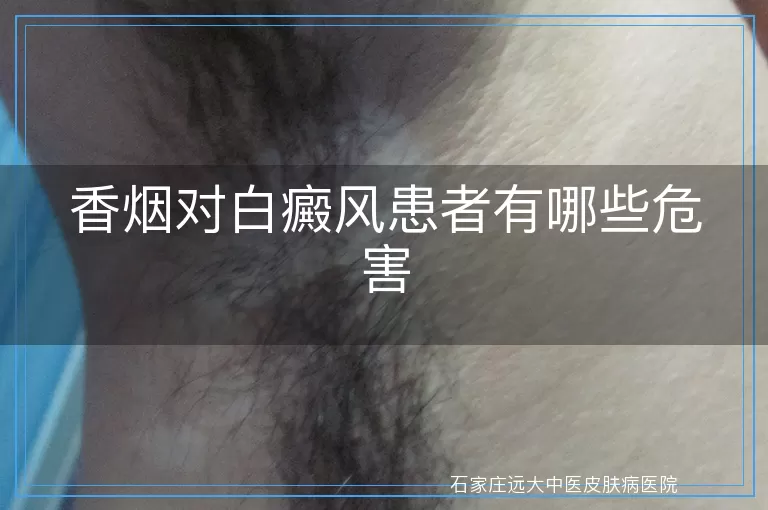 香烟对白癜风患者有哪些危害