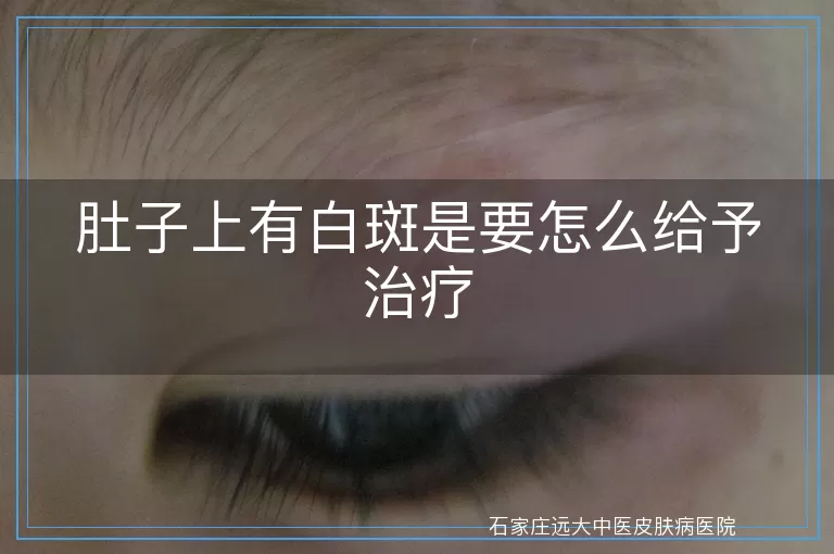肚子上有白斑是要怎么给予治疗