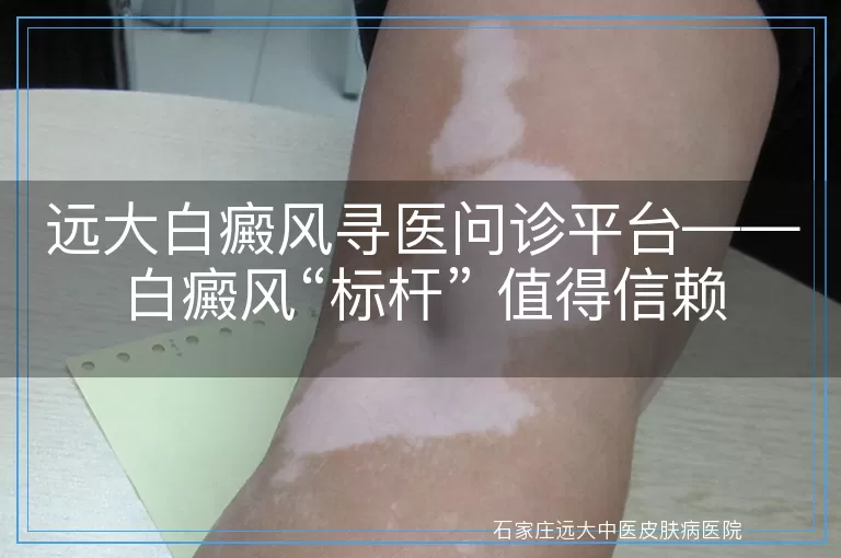 远大白癜风寻医问诊平台——白癜风“标杆” 值得信赖