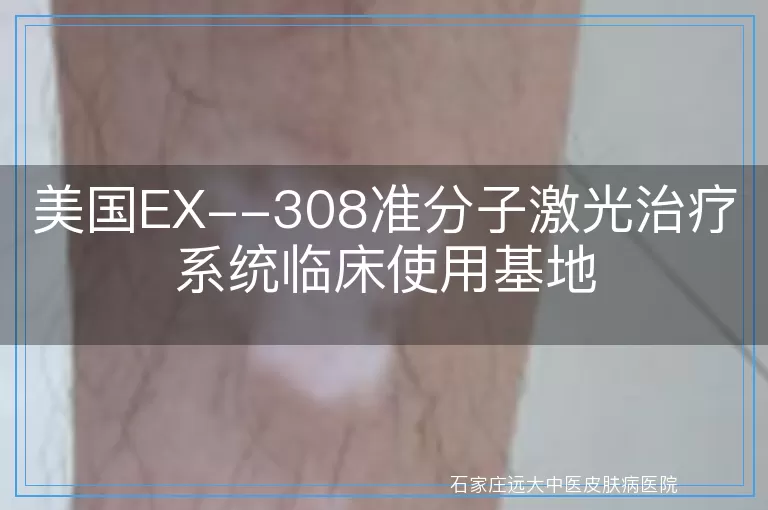 美国EX--308准分子激光治疗系统临床使用基地