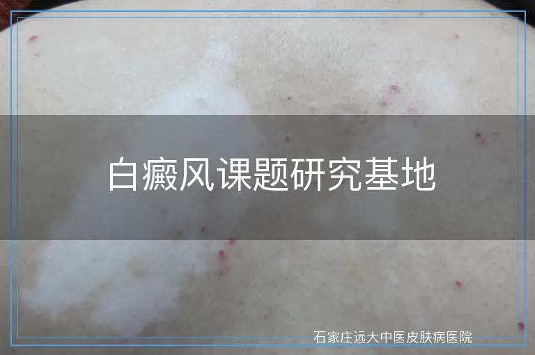 白癜风课题研究基地