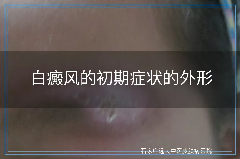 白癜风的初期症状的外形
