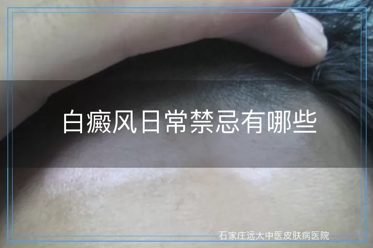 白癜风日常禁忌有哪些