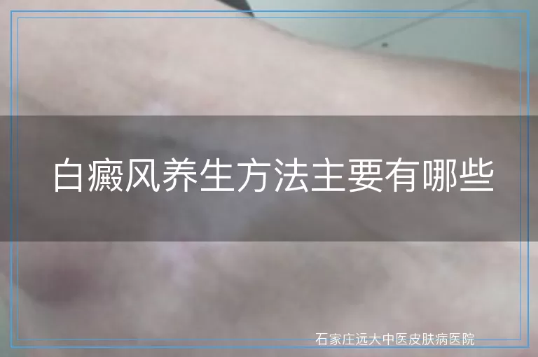 白癜风养生方法主要有哪些