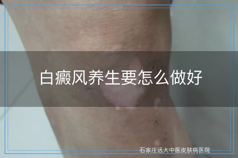 白癜风养生要怎么做好