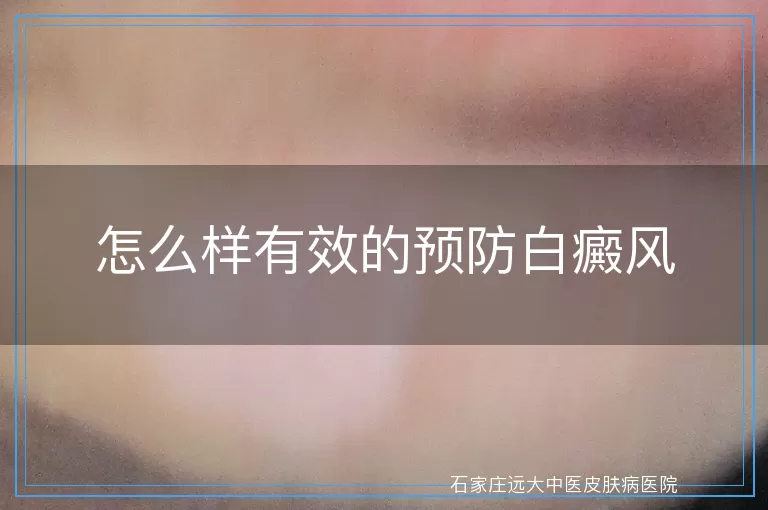 怎么样有效的预防白癜风