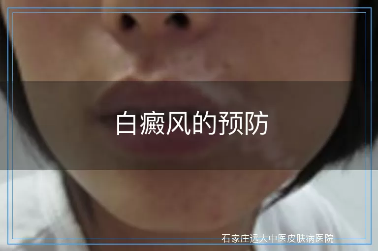 白癜风的预防