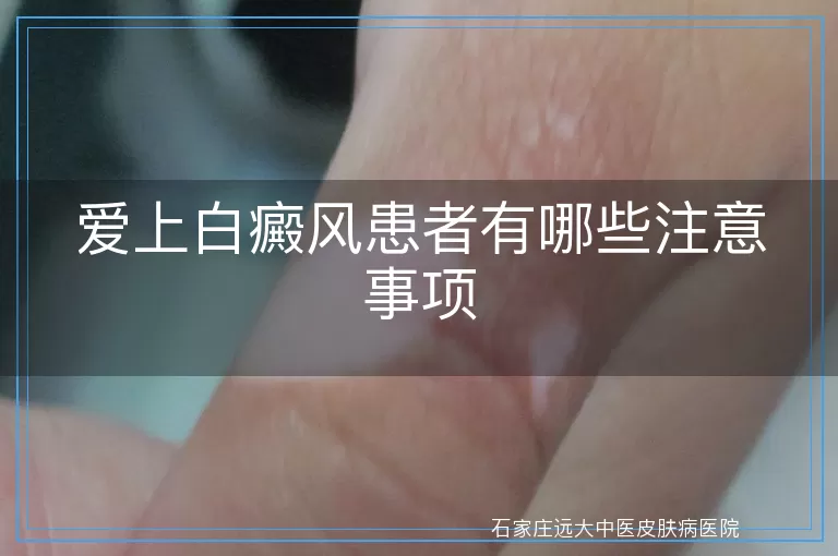 爱上白癜风患者有哪些注意事项