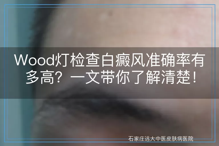 Wood灯检查白癜风准确率有多高？一文带你了解清楚！