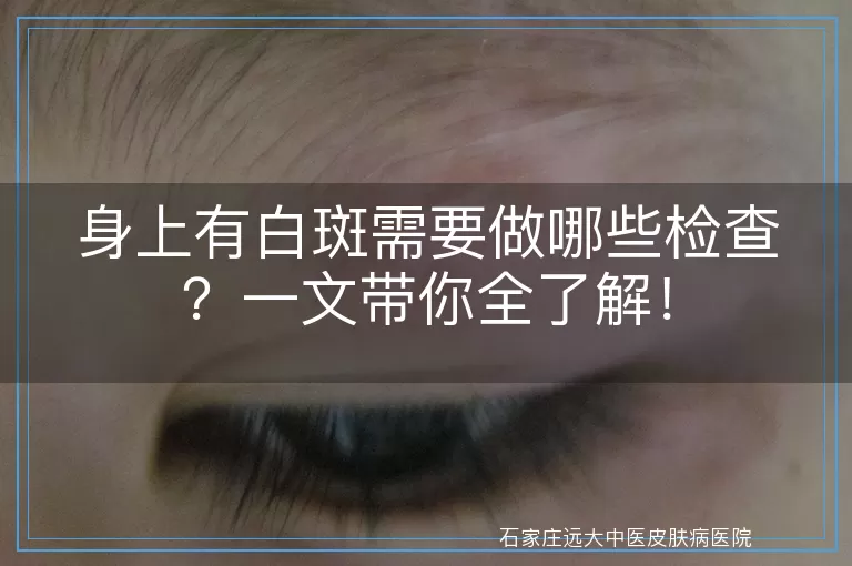 身上有白斑需要做哪些检查?一文带你全了解!