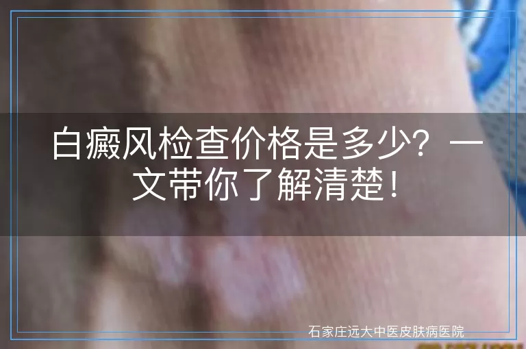 白癜风检查价格是多少？一文带你了解清楚！