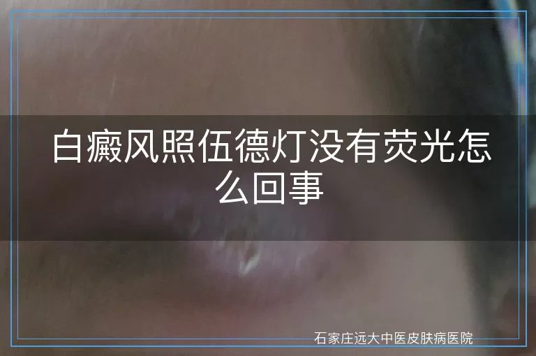 白癜风照伍德灯没有荧光怎么回事