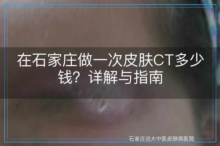 在石家庄做一次皮肤CT多少钱？详解与指南