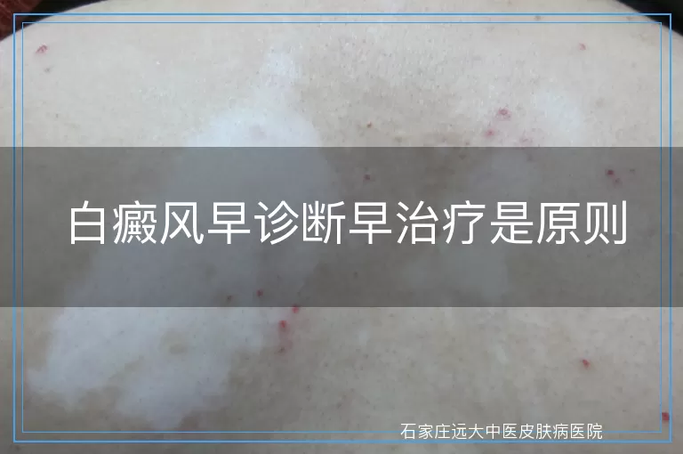 白癜风早诊断早治疗是原则