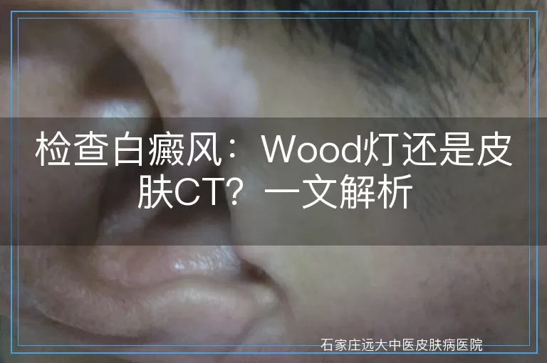 检查白癜风：Wood灯还是皮肤CT？一文解析