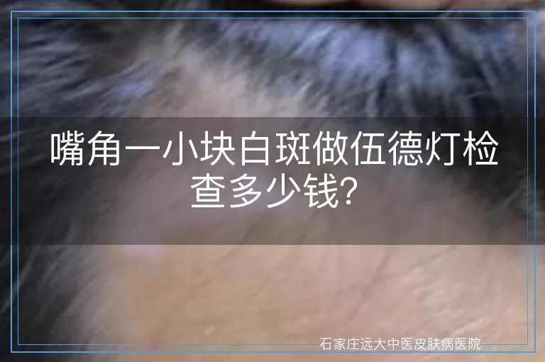 嘴角一小块白斑做伍德灯检查多少钱？