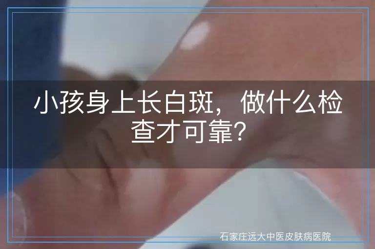 小孩身上长白斑，做什么检查才可靠？