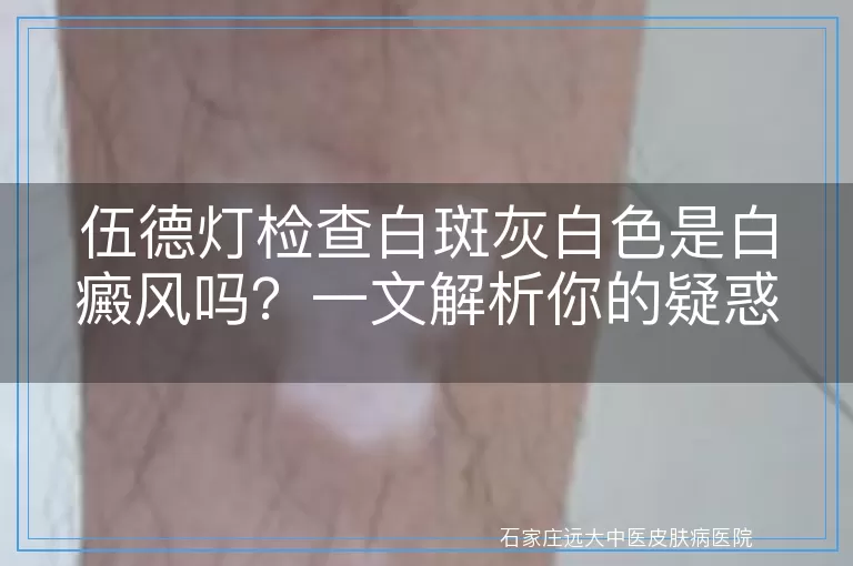 伍德灯检查白斑灰白色是白癜风吗？一文解析你的疑惑