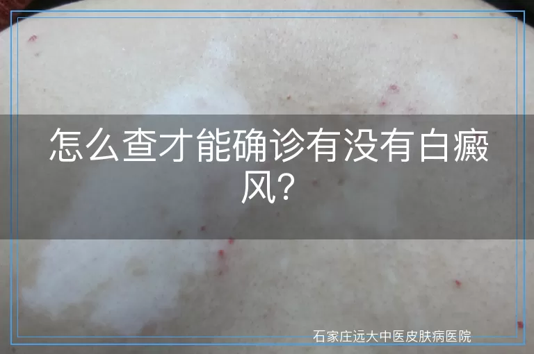 怎么查才能确诊有没有白癜风？