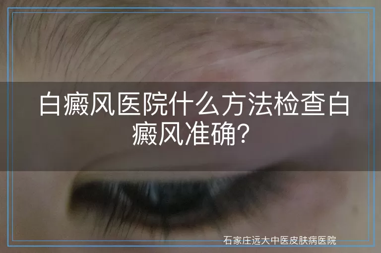 白癜风医院什么方法检查白癜风准确？