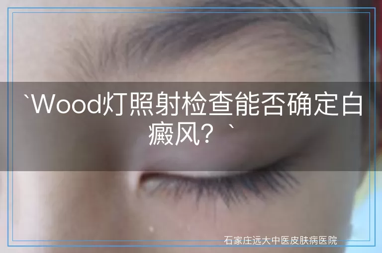 Wood灯照射检查能否确定白癜风？