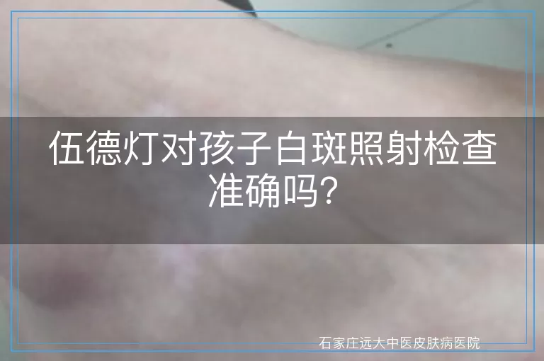 伍德灯对孩子白斑照射检查准确吗？