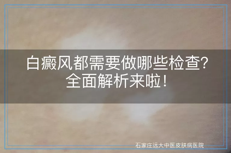 白癜风都需要做哪些检查？全面解析来啦！