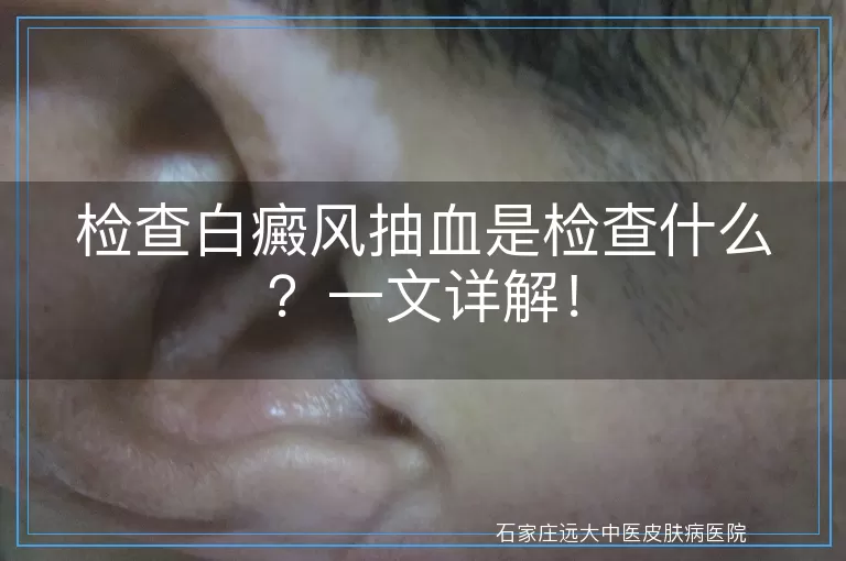 检查白癜风抽血是检查什么？一文详解！