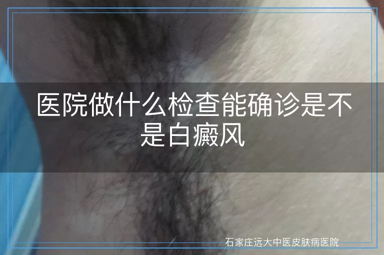医院做什么检查能确诊是不是白癜风