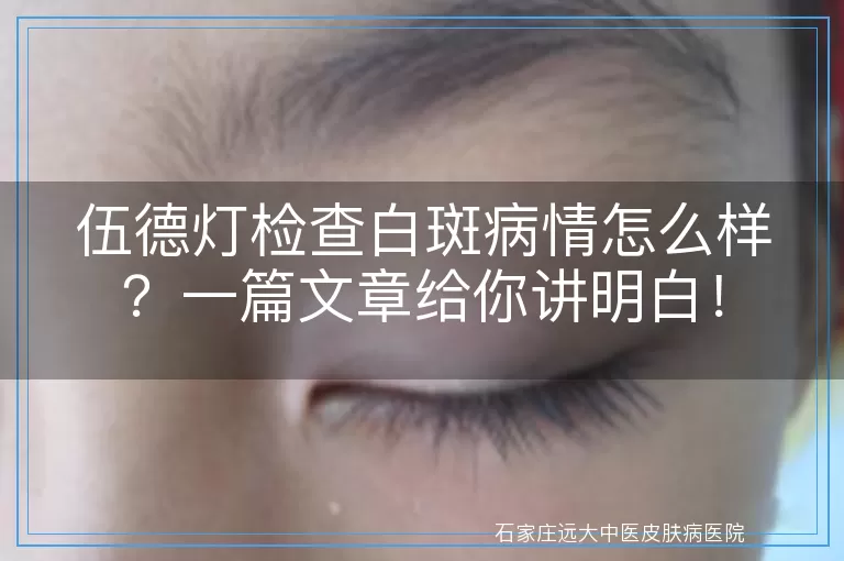 伍德灯检查白斑病情怎么样？一篇文章给你讲明白！