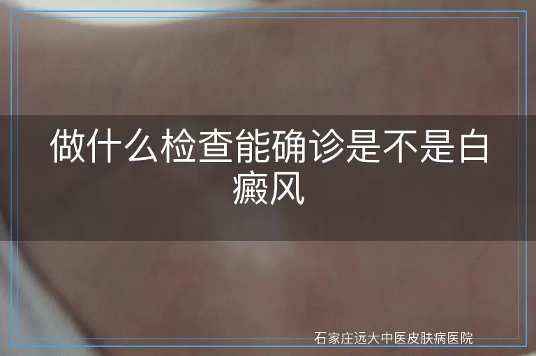 做什么检查能确诊是不是白癜风