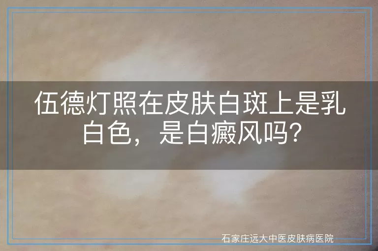 伍德灯照在皮肤白斑上是乳白色，是白癜风吗？