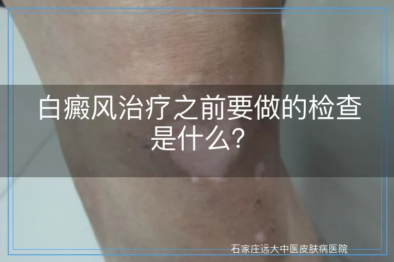 白癜风治疗之前要做的检查是什么？