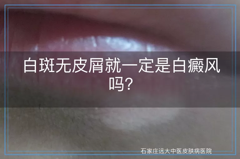 白斑无皮屑就一定是白癜风吗？
