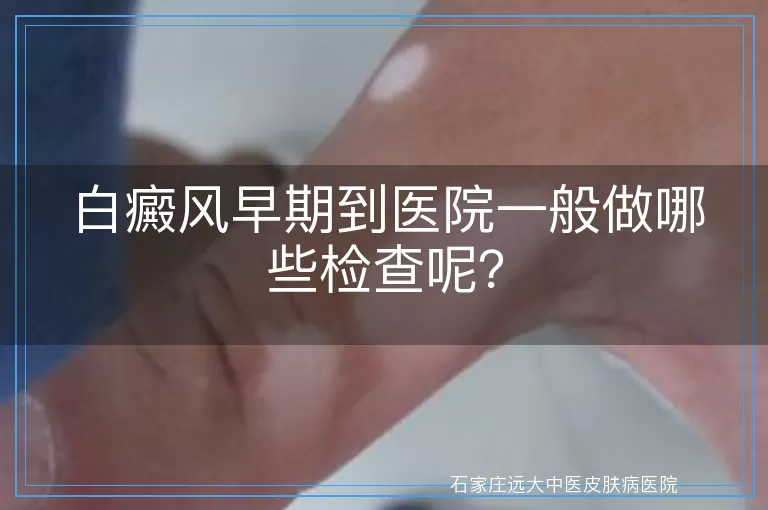 白癜风早期到医院一般做哪些检查呢？