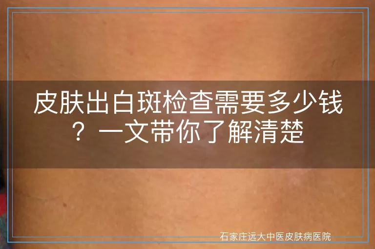 皮肤出白斑检查需要多少钱？一文带你了解清楚