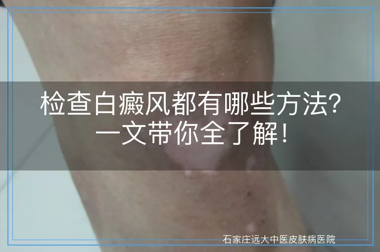 检查白癜风都有哪些方法？一文带你全了解！