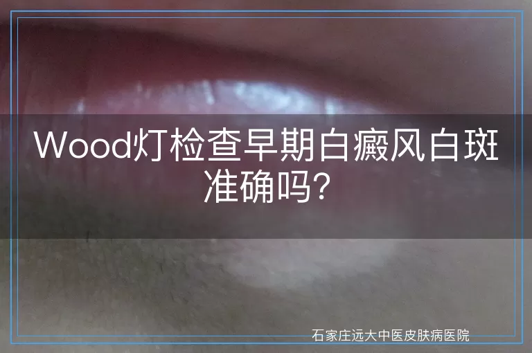 Wood灯检查早期白癜风白斑准确吗？