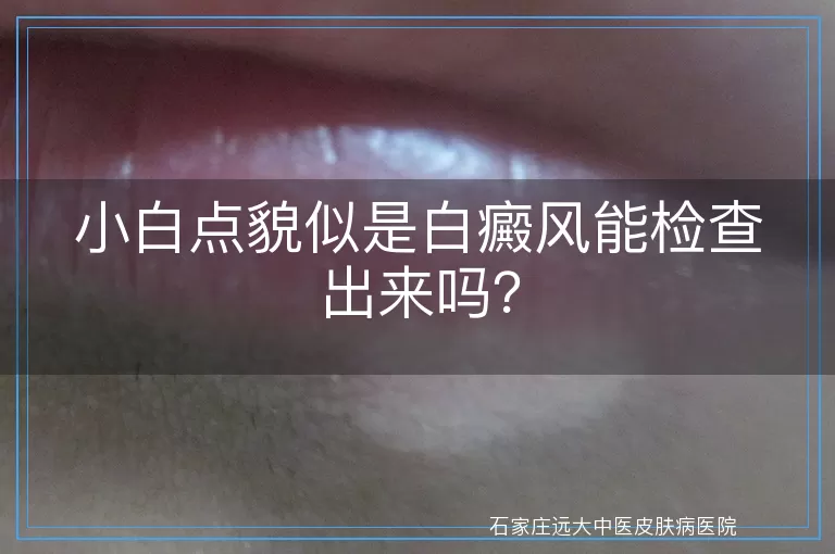 小白点貌似是白癜风能检查出来吗？