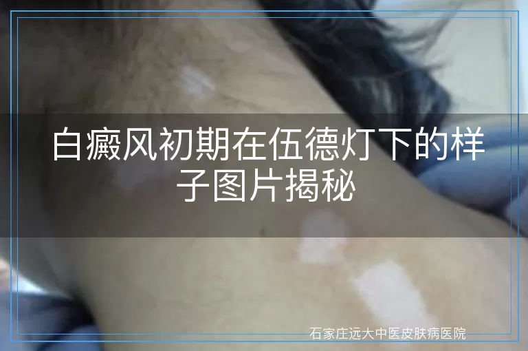 白癜风初期在伍德灯下的样子图片揭秘