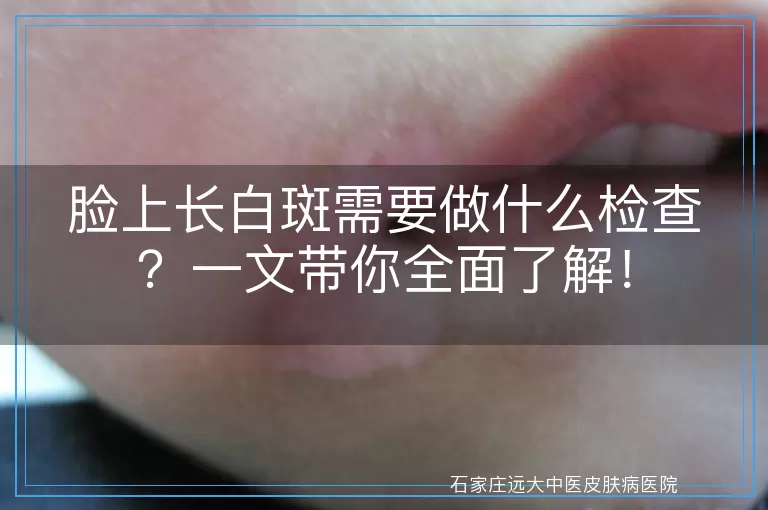 脸上长白斑需要做什么检查？一文带你全面了解！