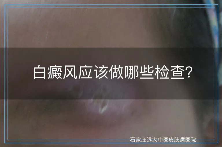 白癜风应该做哪些检查？