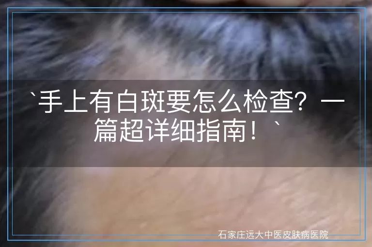 手上有白斑要怎么检查？一篇超详细指南！