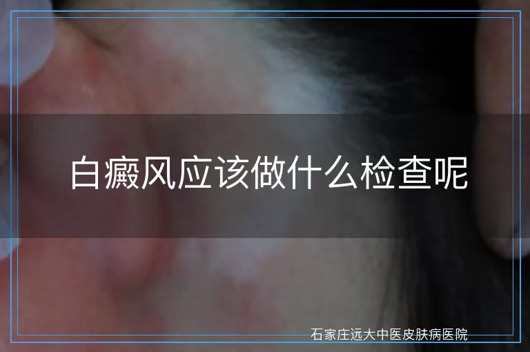 白癜风应该做什么检查呢
