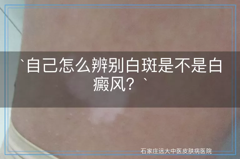 自己怎么辨别白斑是不是白癜风？